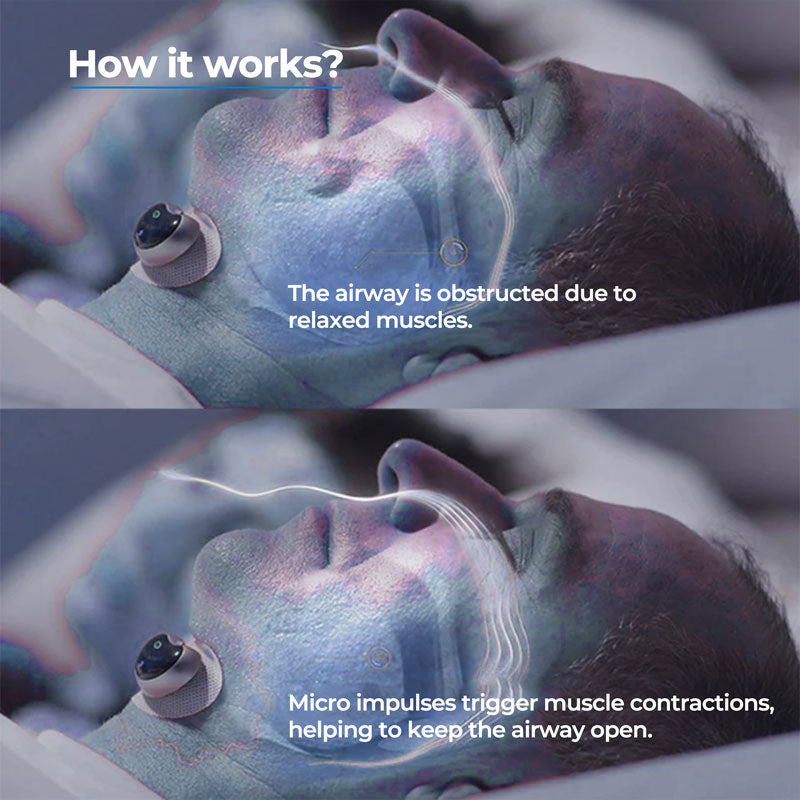 Anti-Snoring Device Kinclip Sleep Aid for Peaceful Nights 1